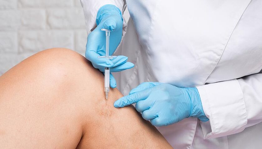 procedure sclerotherapy of varicose veins