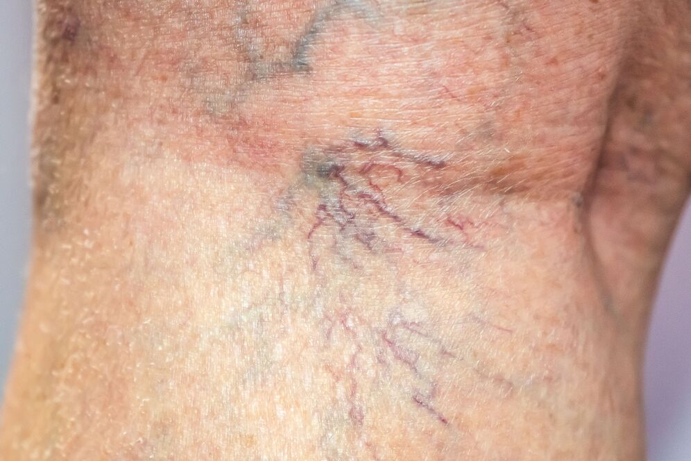 varicose veins on the body