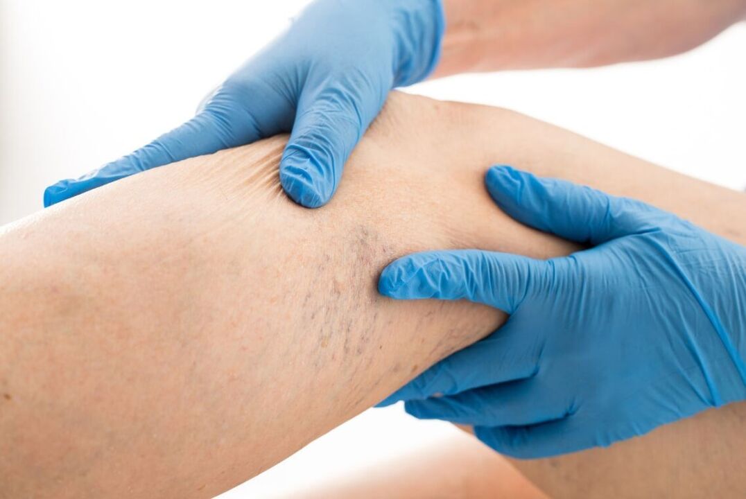 Clinical disease in picture varicose veins