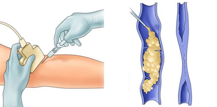 Varicose veins