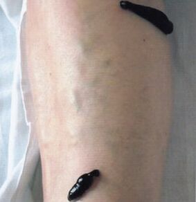 Hirudotherapy as a method of treating varicose veins