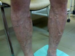 Varicose veins on the legs