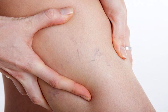 The first manifestations of varicose veins on the legs