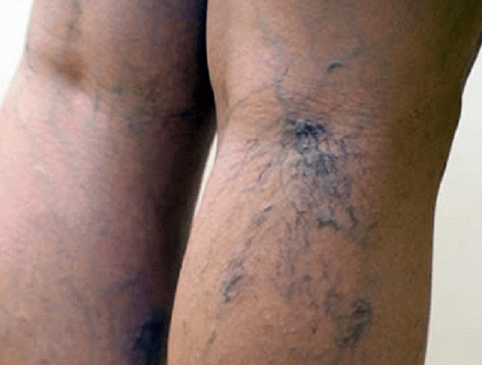 varicose veins on the legs